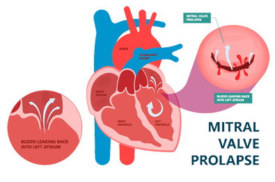 Ayurvedic Treatment For Mitral Valve Prolapse